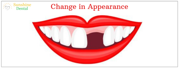 Change in Appearance | Best Dental Replacement in Whitefield