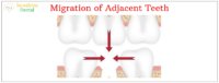 Migration of Adjacent Teeth | Best Dental Replacement in Whitefield