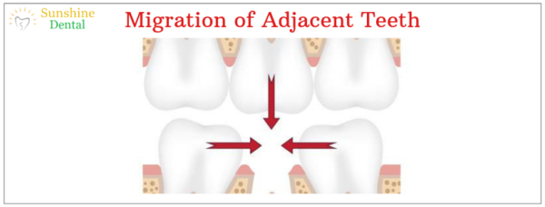 Migration of Adjacent Teeth | Best Dental Replacement in Whitefield