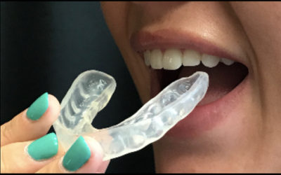 Sports Mouth Guard | Best Dental Services in Whitefield | Bangalore | Sunshine Dental