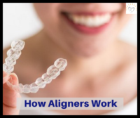 How Clear Aligners Work | Orthodontic Treatment with Clear Aligners How Clear Aligners Work | Orthodontic Treatment with Clear Aligners