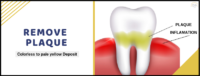 Remove Plaque | Best Dental Care Treatment In Whitefield Remove Plaque | Best Dental Care Treatment In Whitefield