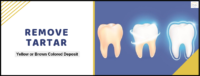Remove Tartar | Best Dental Care Treatment In Whitefield Remove Tartar | Best Dental Care Treatment In Whitefield