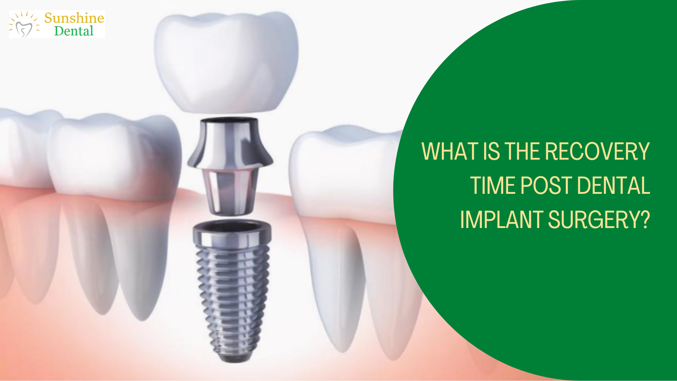 Recovery time post dental implant surgery, Best Dental Implants in Bangalore