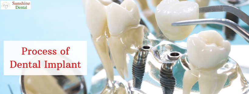 Process of Dental Implants in Whitefield, Bangalore at Sunshine Dental