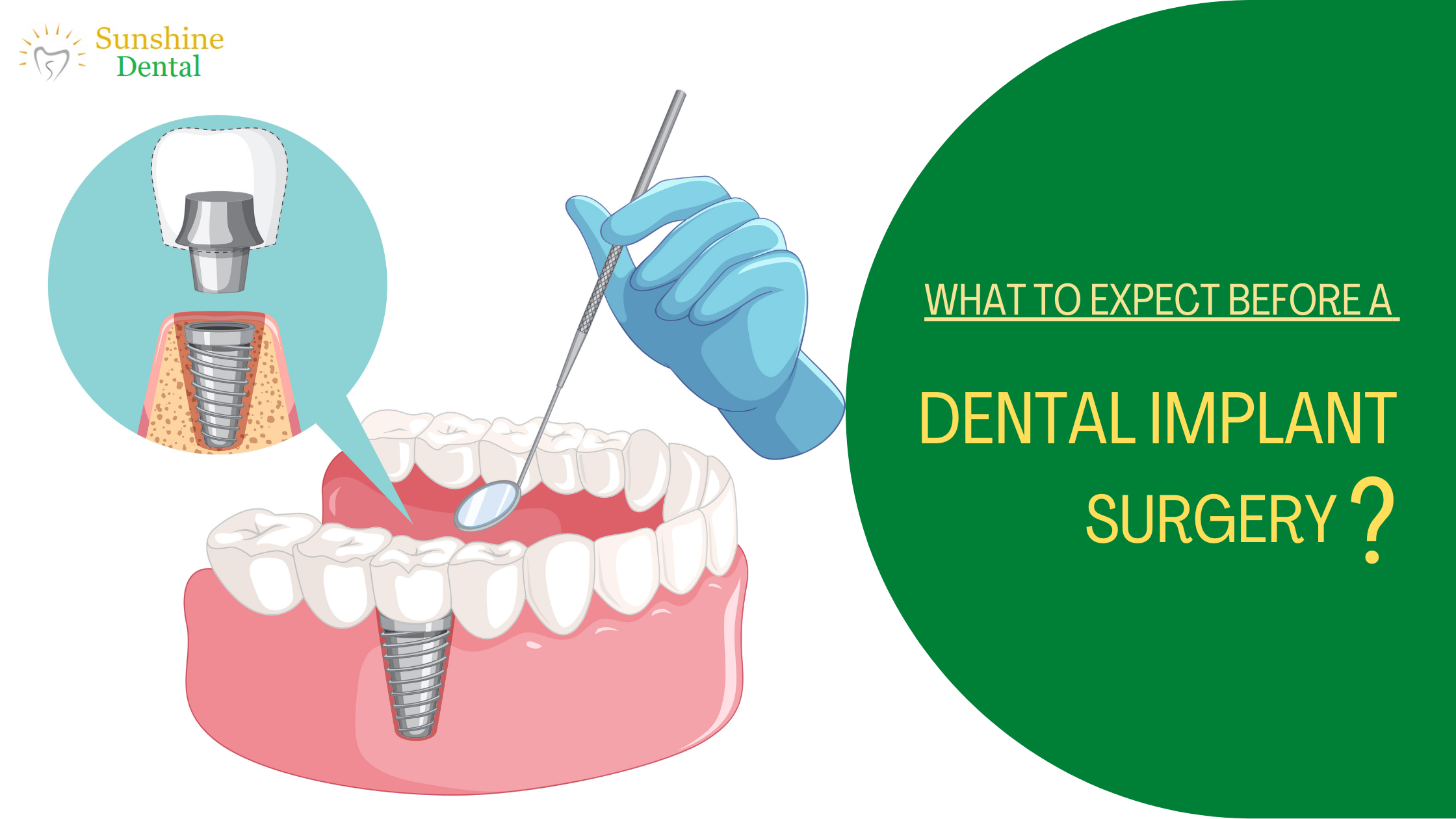 What to Expect Before a Dental Implant Surgery Best Dental Implants in Bangalore