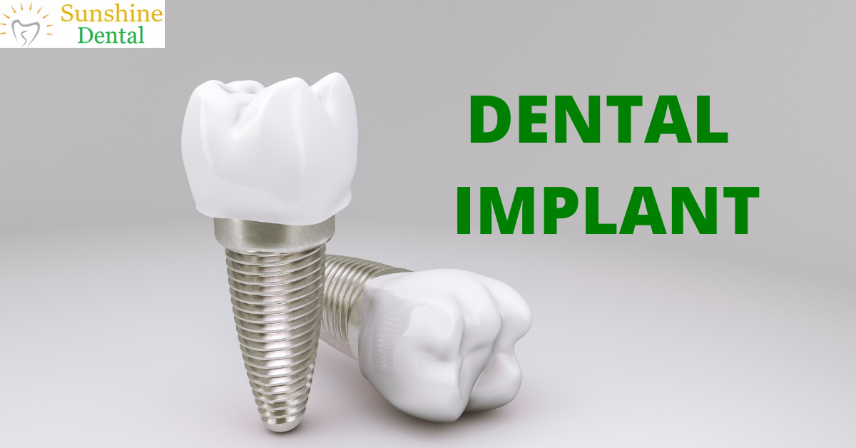 Best Dental Implant Treatment Clinic In Whitefield